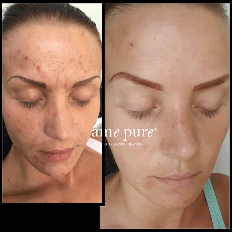 CIT Face Roller PLATINUM